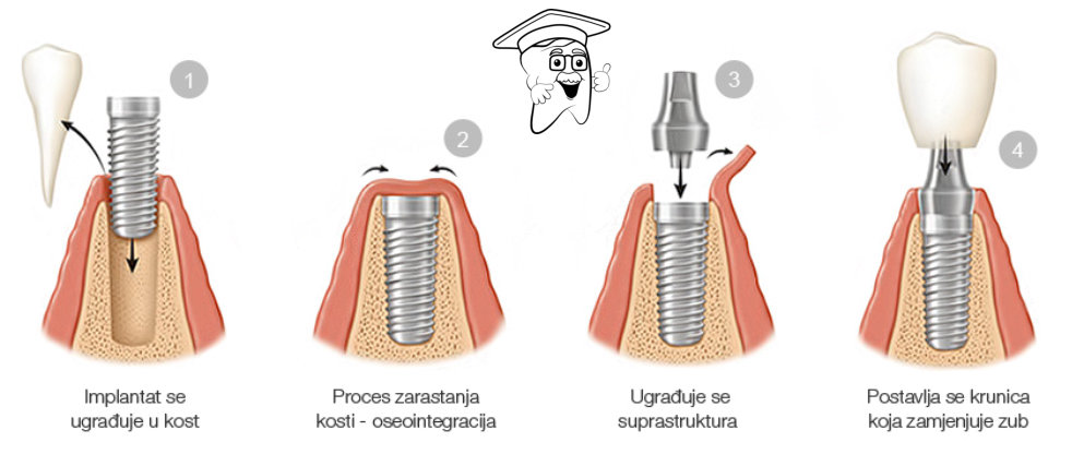 implantat postupak ugradnje